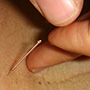 L’acupuncture